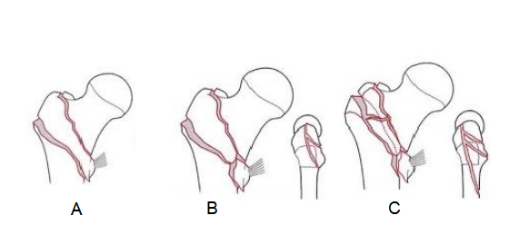 股骨粗隆间骨折的髓内钉手术治疗技术