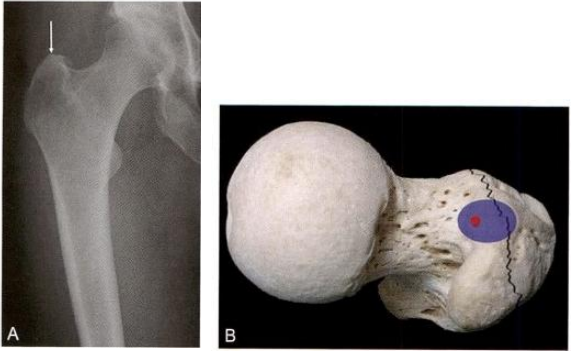 股骨粗隆间骨折的髓内钉手术治疗技术