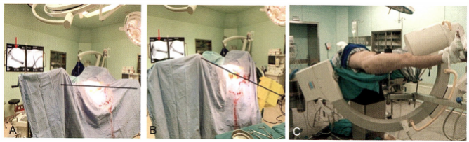 股骨粗隆间骨折的髓内钉手术治疗技术
