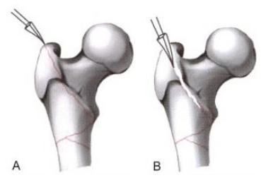 股骨粗隆间骨折的髓内钉手术治疗技术