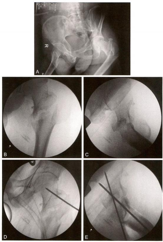 股骨粗隆间骨折的髓内钉手术治疗技术