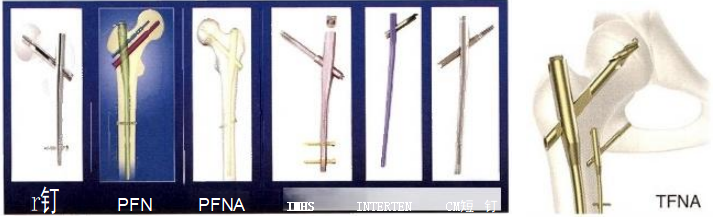 股骨粗隆间骨折的髓内钉手术治疗技术