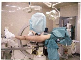 股骨粗隆间骨折的髓内钉手术治疗技术