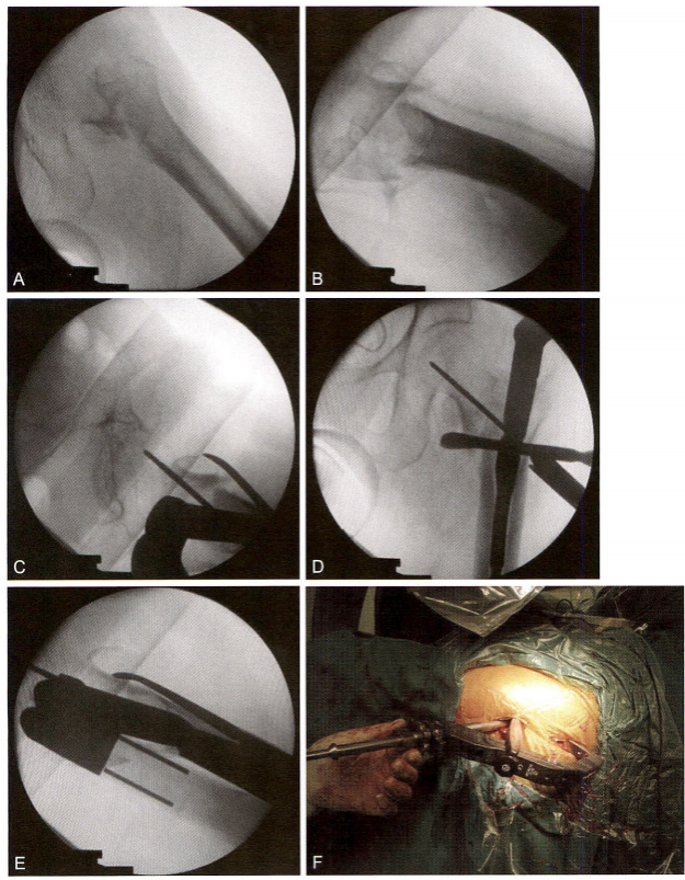 股骨粗隆间骨折的髓内钉手术治疗技术
