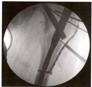 股骨粗隆间骨折的髓内钉手术治疗技术