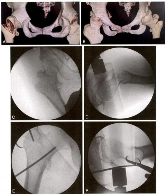 股骨粗隆间骨折的髓内钉手术治疗技术
