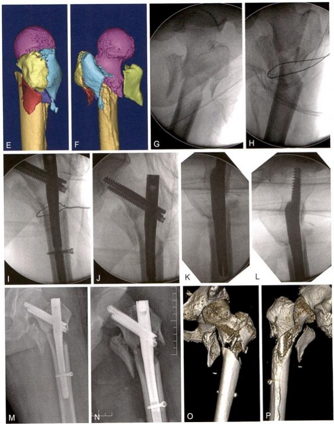 股骨粗隆间骨折的髓内钉手术治疗技术