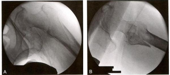 股骨粗隆间骨折的髓内钉手术治疗技术