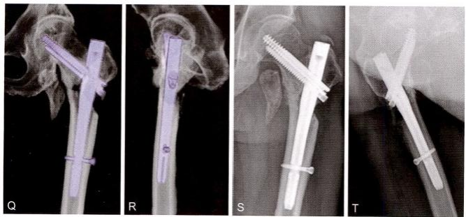 股骨粗隆间骨折的髓内钉手术治疗技术