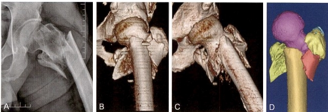 股骨粗隆间骨折的髓内钉手术治疗技术