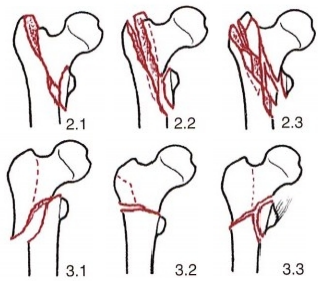 股骨粗隆间骨折的髓内钉手术治疗技术