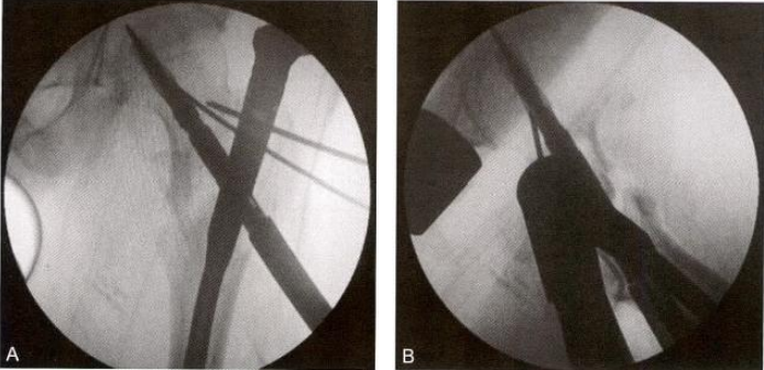 股骨粗隆间骨折的髓内钉手术治疗技术