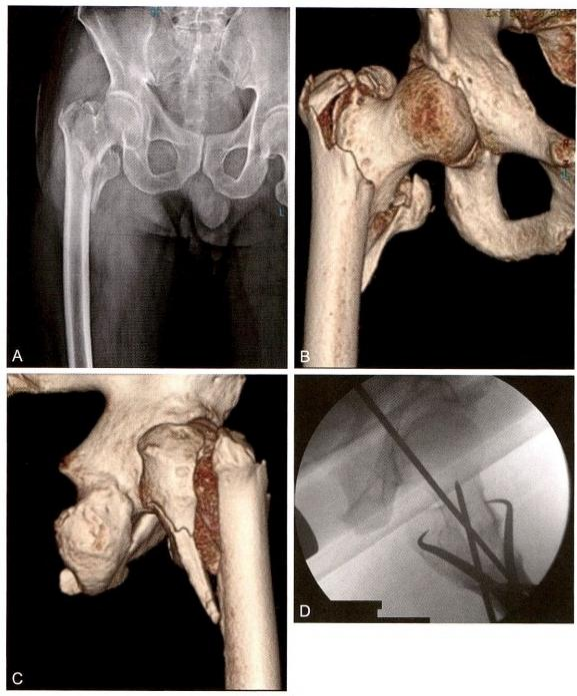 股骨粗隆间骨折的髓内钉手术治疗技术
