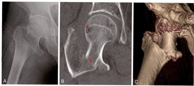 股骨粗隆间骨折的髓内钉手术治疗技术