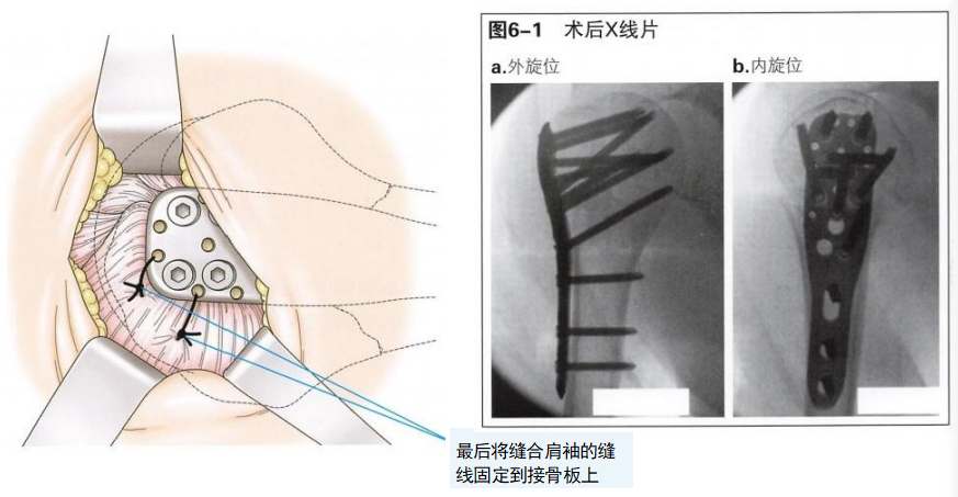【创伤】肱骨近端骨折切开复位内固定手术技术