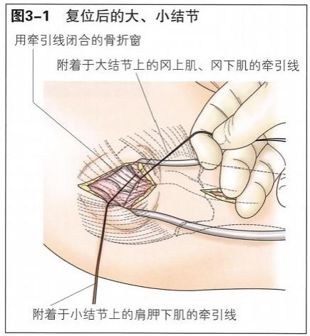 【创伤】肱骨近端骨折切开复位内固定手术技术