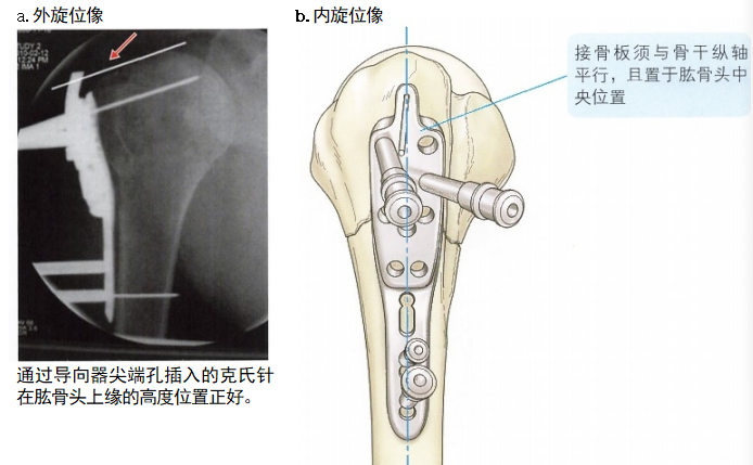 【创伤】肱骨近端骨折切开复位内固定手术技术