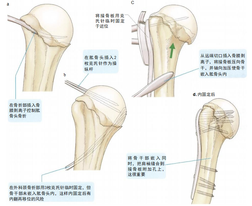 【创伤】肱骨近端骨折切开复位内固定手术技术