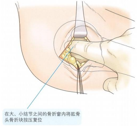 【创伤】肱骨近端骨折切开复位内固定手术技术
