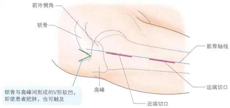 【创伤】肱骨近端骨折切开复位内固定手术技术