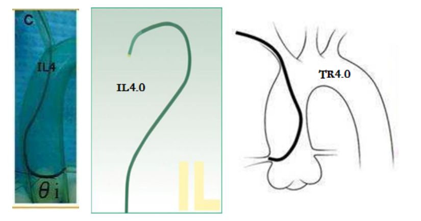冠脉介入先利器——关于指引导管的那些事儿