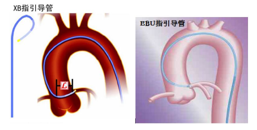 冠脉介入先利器——关于指引导管的那些事儿