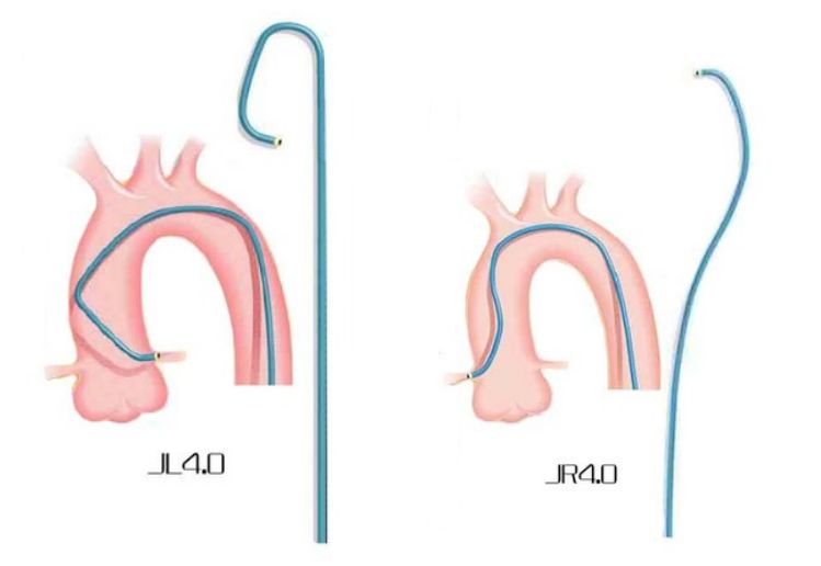 冠脉介入先利器——关于指引导管的那些事儿