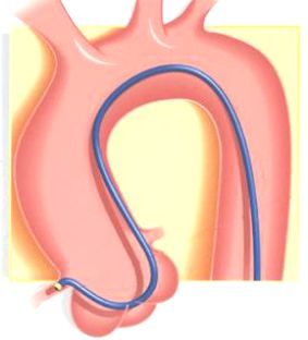 冠脉介入先利器——关于指引导管的那些事儿