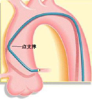 冠脉介入先利器——关于指引导管的那些事儿