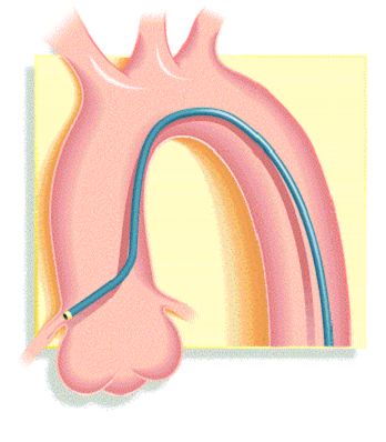 冠脉介入先利器——关于指引导管的那些事儿