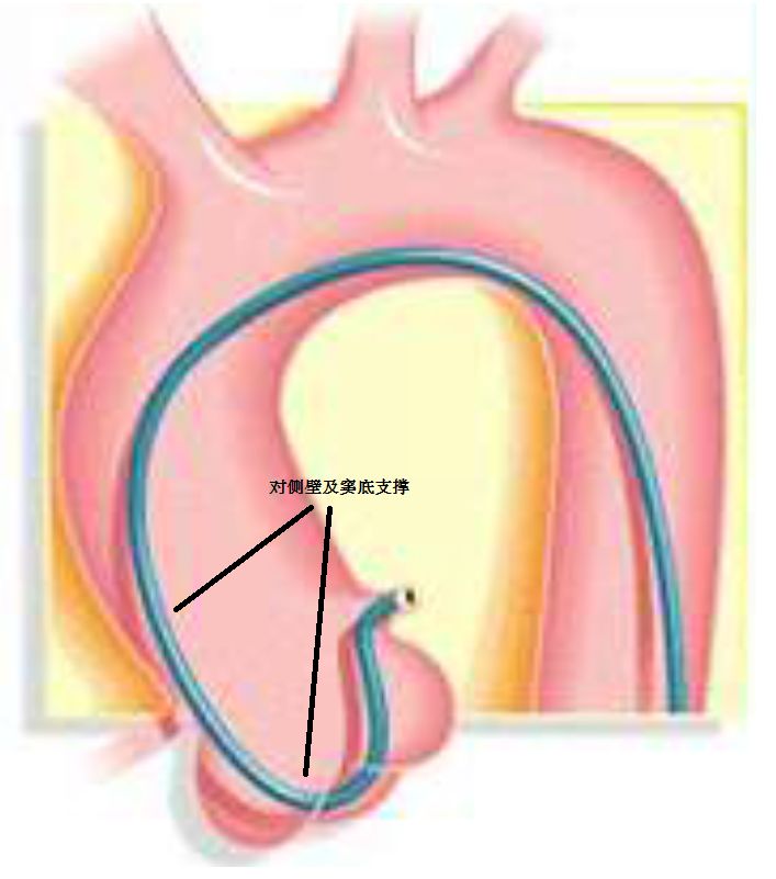 冠脉介入先利器——关于指引导管的那些事儿