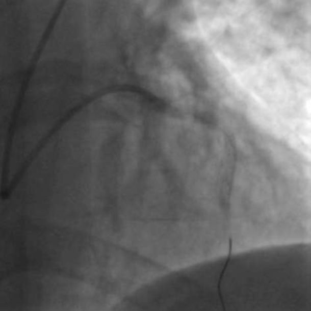 冠脉介入先利器——关于指引导管的那些事儿