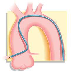 冠脉介入先利器——关于指引导管的那些事儿