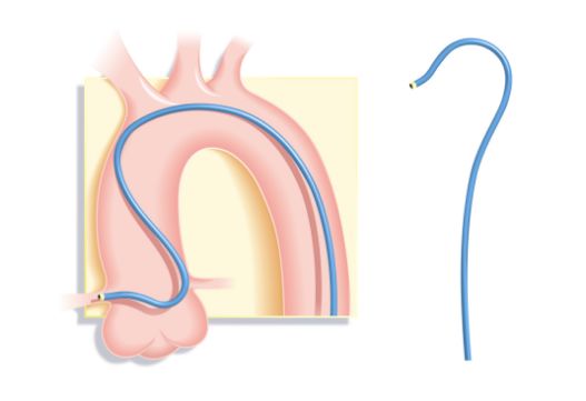 冠脉介入先利器——关于指引导管的那些事儿