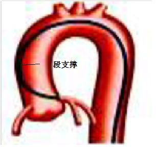 冠脉介入先利器——关于指引导管的那些事儿