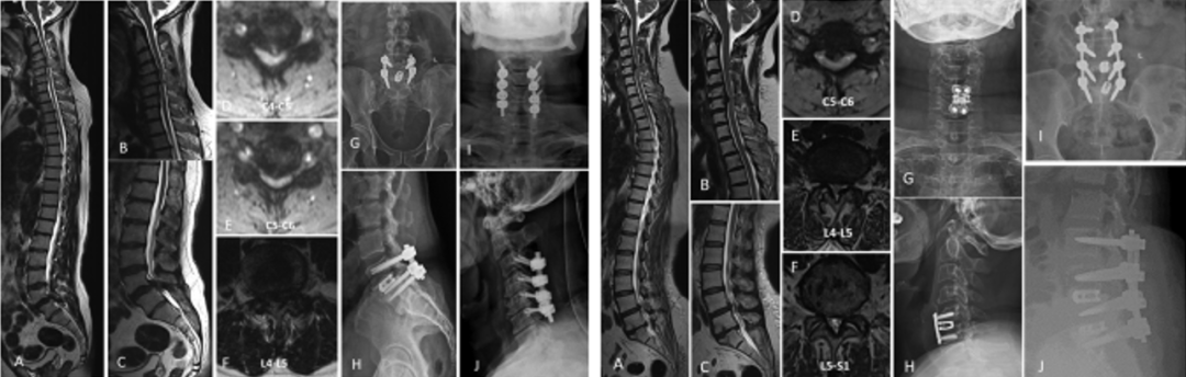 【文献精读】串联型椎管狭窄症的分型和治疗策略