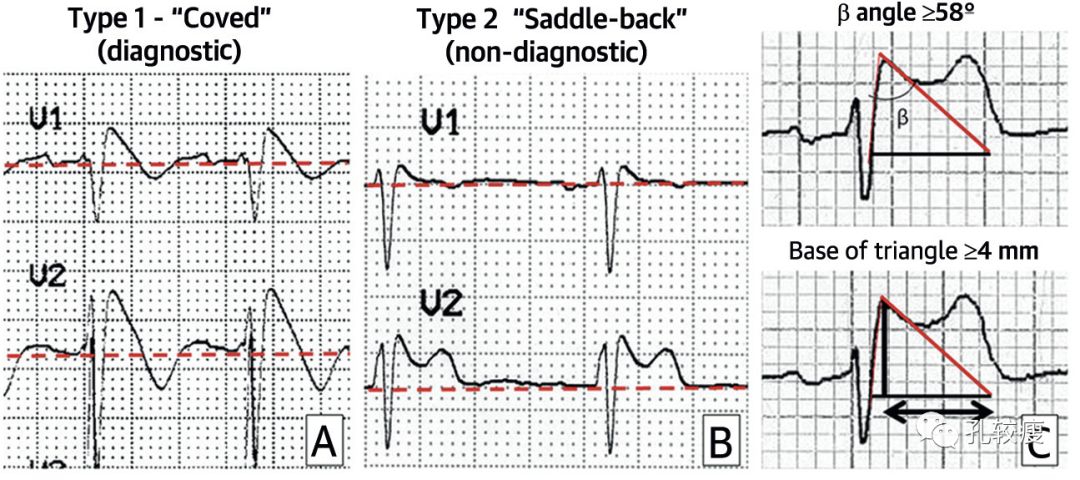 这些特征心电图改变，都是猝死的前兆