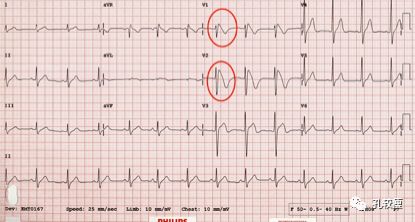 这些特征心电图改变，都是猝死的前兆