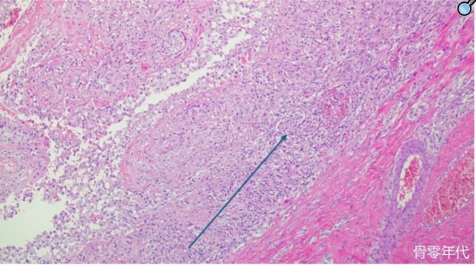 全髋关节置换术后关节周围积液的症状：是败血症还是无菌并发症？