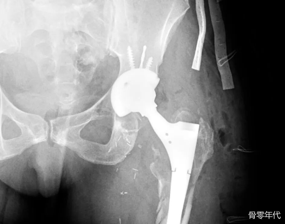 全髋关节置换术后关节周围积液的症状：是败血症还是无菌并发症？