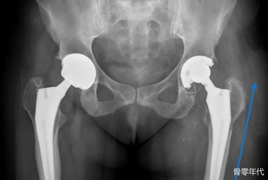 全髋关节置换术后关节周围积液的症状：是败血症还是无菌并发症？