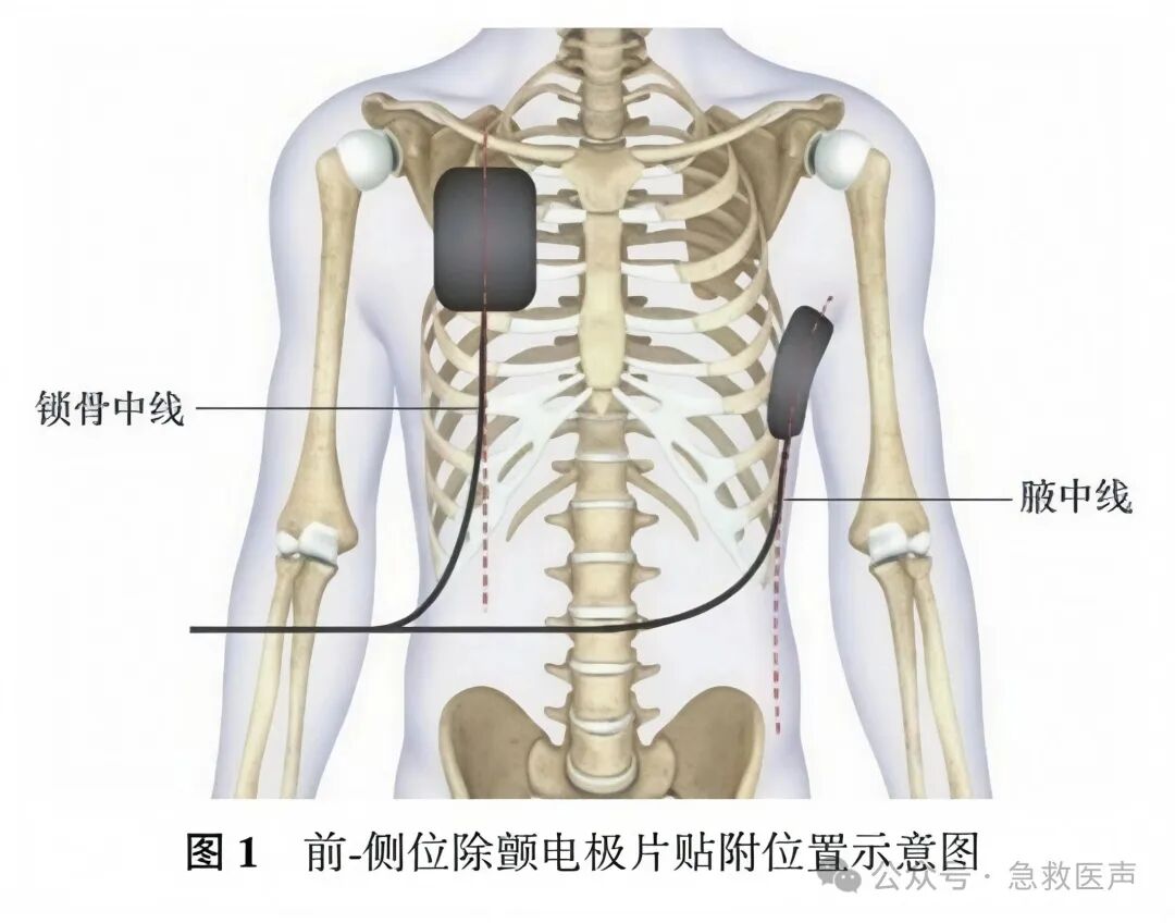 一次性除颤电极片院内使用中国专家共识（2026版）