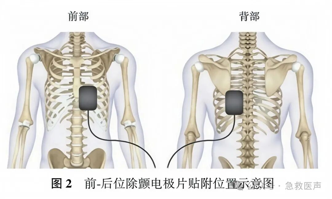 一次性除颤电极片院内使用中国专家共识（2026版）
