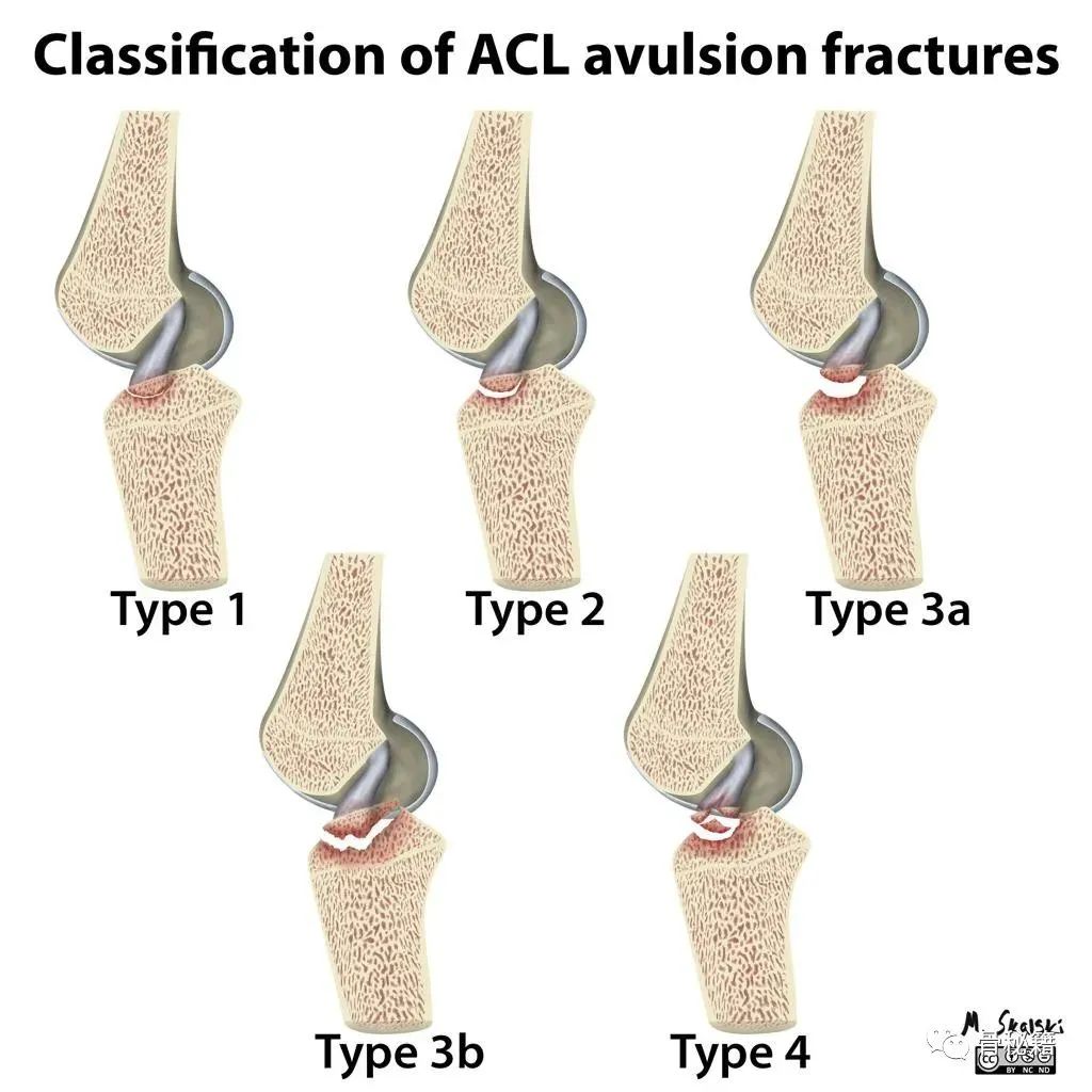 ACL前叉韧带损伤的分度、分型与治疗