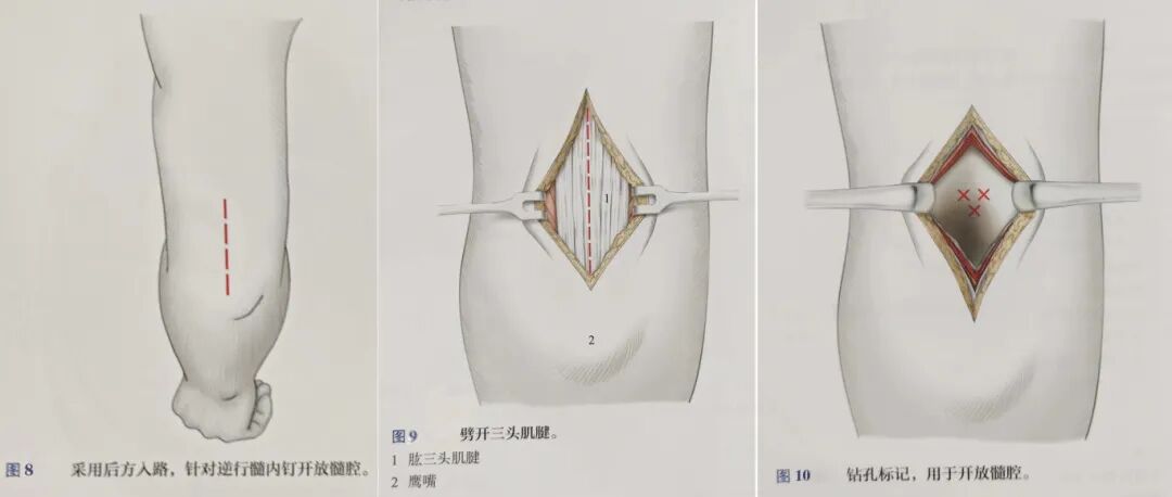 肱骨手术入路大全，赶紧收藏起来！