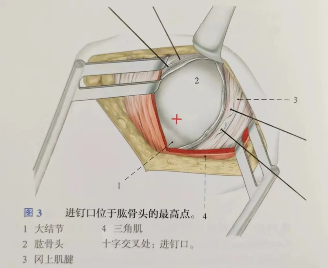 肱骨手术入路大全，赶紧收藏起来！