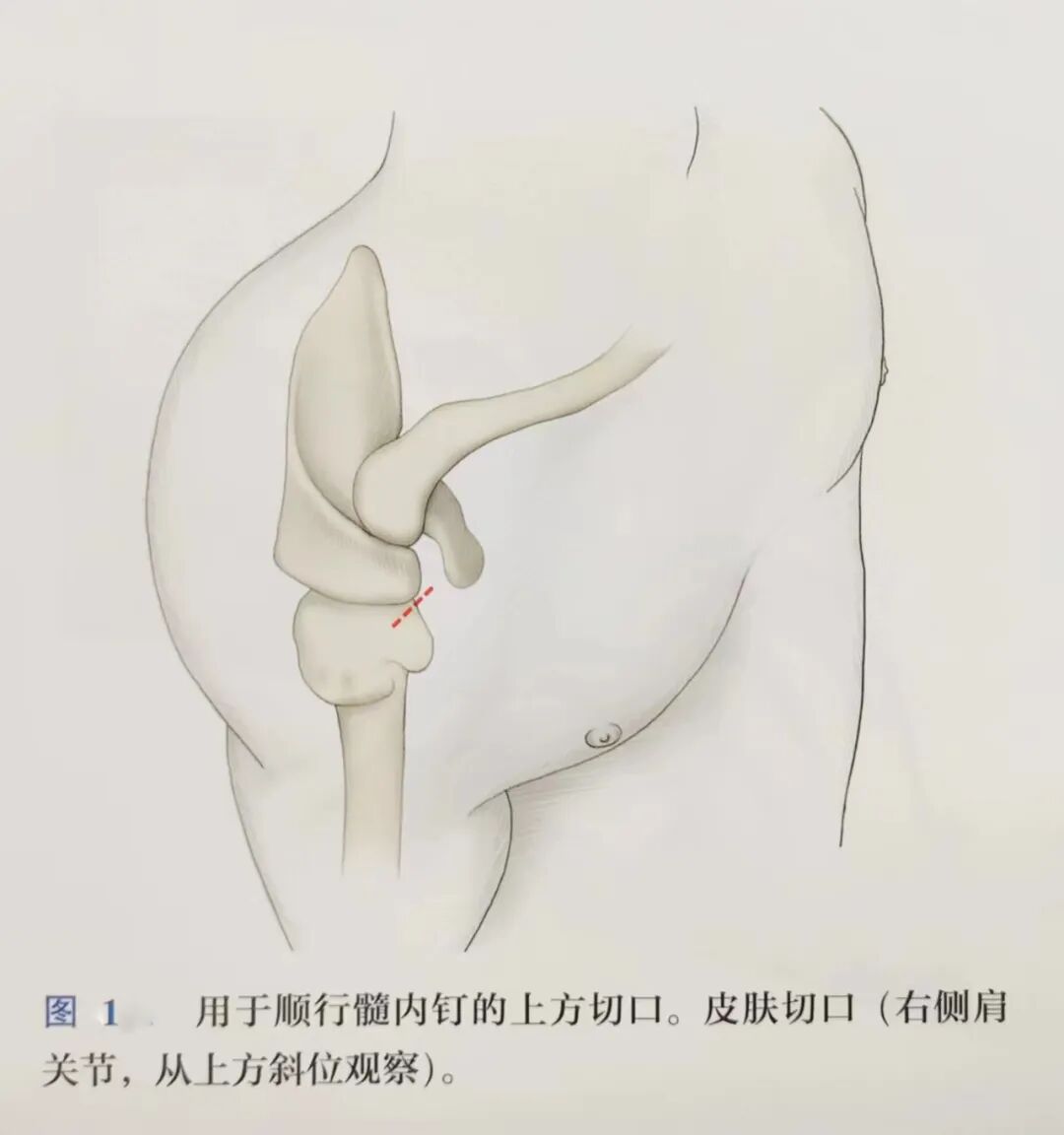 肱骨手术入路大全，赶紧收藏起来！