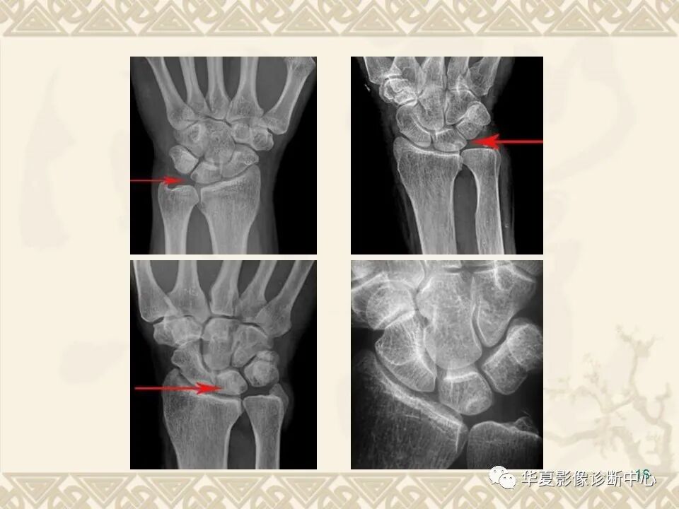 临床上常用的骨关节X线测量方法图文详解
