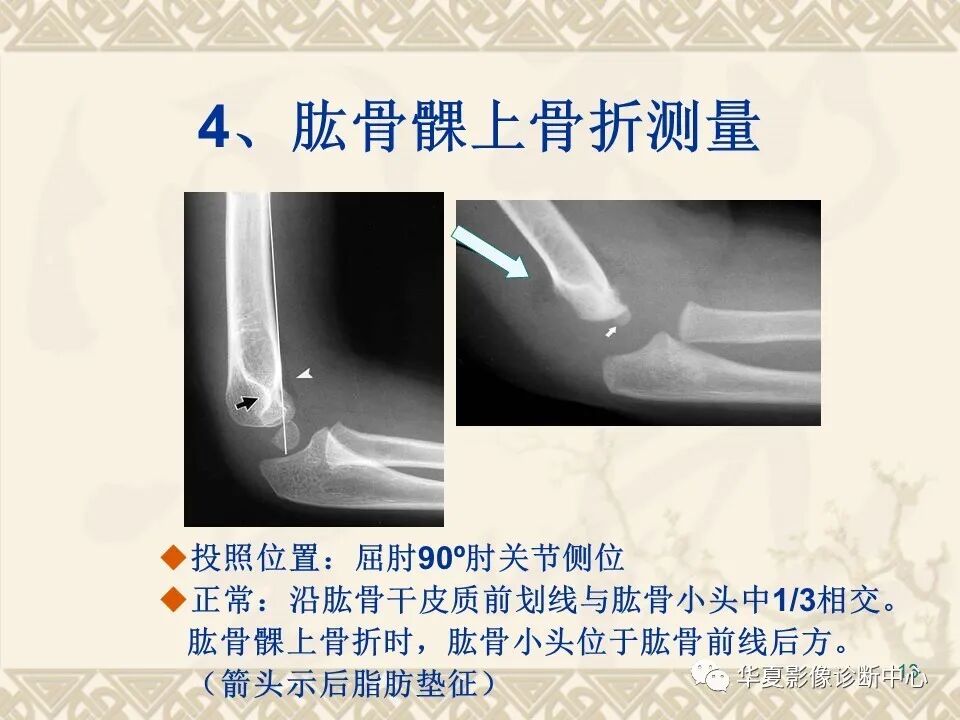 临床上常用的骨关节X线测量方法图文详解