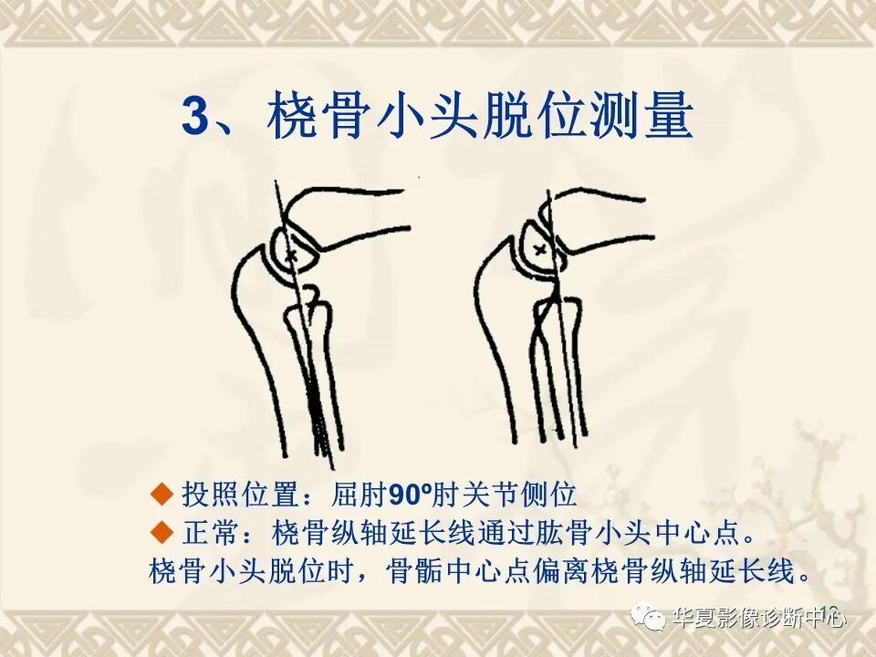 临床上常用的骨关节X线测量方法图文详解